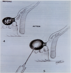 Rubber band ligation - kolhapurpilesclinic