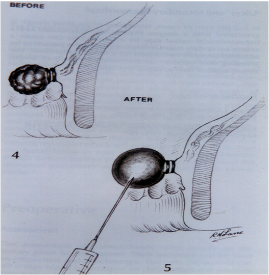 Rubber Band Ligation Kolhapurpilesclinic   Picture6 